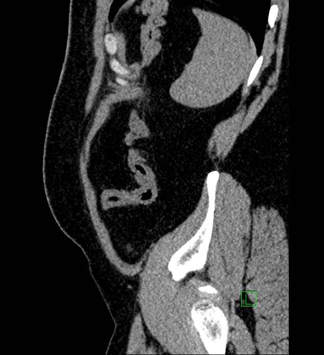 Chromophobe renal cell carcinoma (Radiopaedia 84286-99573 C 20).jpg