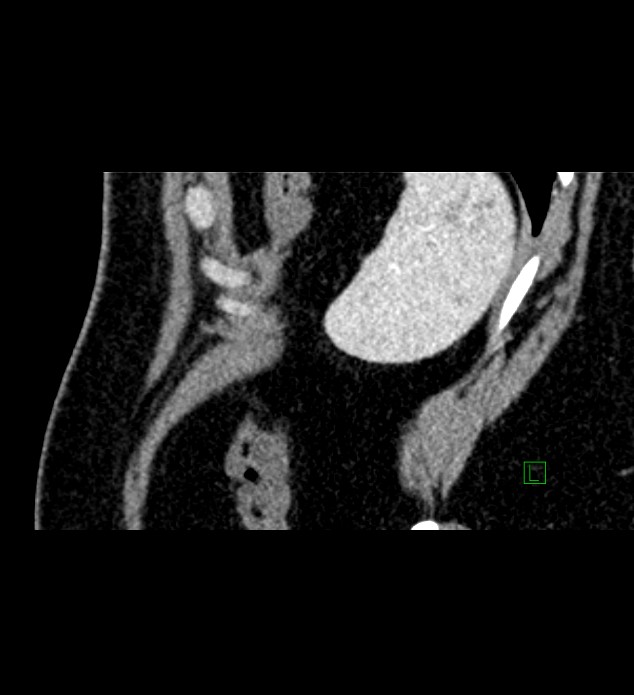 Chromophobe renal cell carcinoma (Radiopaedia 84286-99573 F 13).jpg