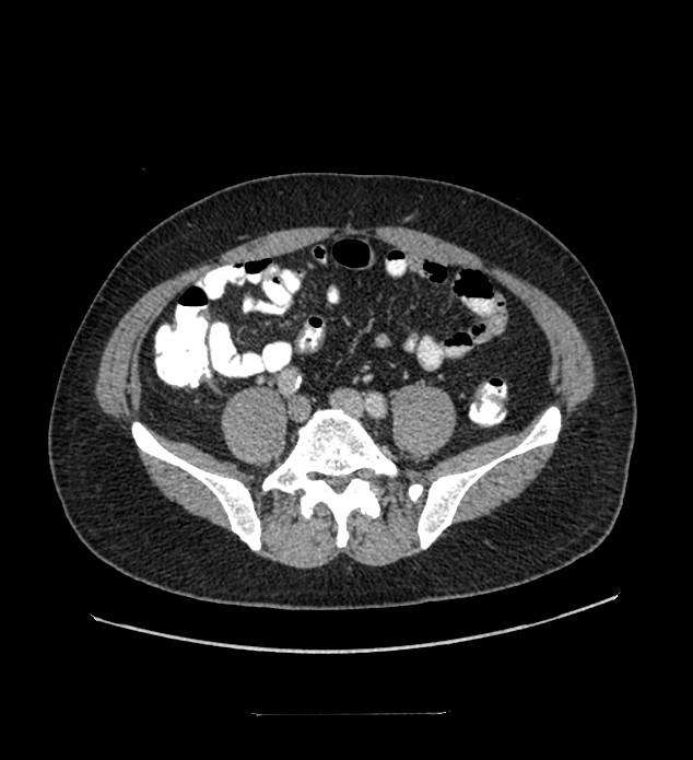 Chromophobe renal cell carcinoma (Radiopaedia 84337-99644 C 91).jpg
