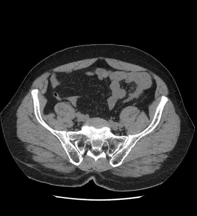 Chromophobe renal cell carcinoma (Radiopaedia 86879-103083 Axial non-contrast 95).jpg