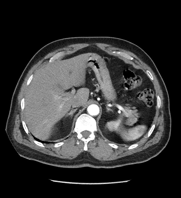 Chromophobe renal cell carcinoma (Radiopaedia 86879-103083 B 35).jpg