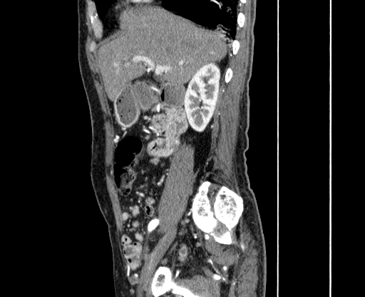 Chronic contained rupture of abdominal aortic aneurysm with extensive erosion of the vertebral bodies (Radiopaedia 55450-61901 B 3).jpg