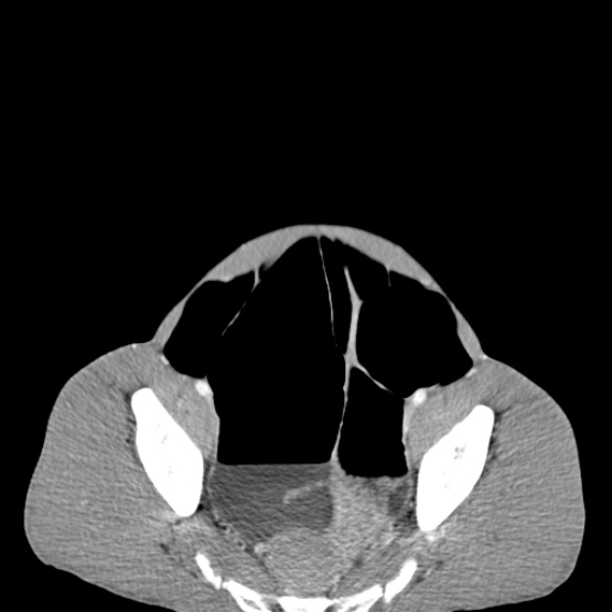 Chronic large bowel pseudo-obstruction (Radiopaedia 43181-46492 A 144).jpg