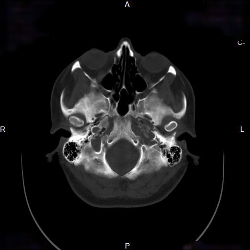 File:Chronic maxillary sinusitis with a foreign body (dental filling material) (Radiopaedia 7811-8639 Axial bone window 9).jpg