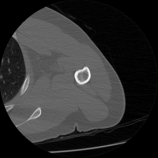 Chronic osteomyelitis (Radiopaedia 67597-76998 Axial bone window 16).jpg