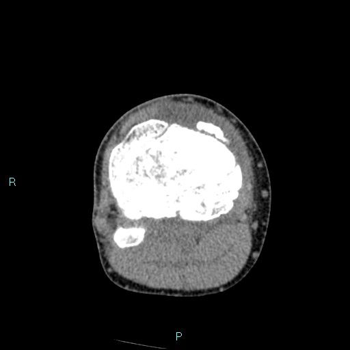 Chronic osteomyelitis (with Brodie abscess) (Radiopaedia 76405-88111 A 91).jpg