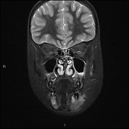 File:Chronic reactive multifocal osteomyelitis (CRMO) - mandible (Radiopaedia 56405-63069 Coronal STIR 11).jpg