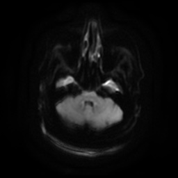 Chronic submandibular sialadenitis (Radiopaedia 61852-69885 Axial DWI 3).jpg