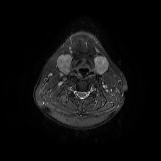 File:Chronic submandibular sialadenitis (Radiopaedia 61852-69885 Axial STIR 17).jpg