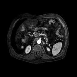 Cirrhosis and hepatocellular carcinoma in the setting of hemochromatosis (Radiopaedia 75394-86594 Axial T1 C+ fat sat 126).jpg