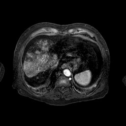 Cirrhosis and hepatocellular carcinoma in the setting of hemochromatosis (Radiopaedia 75394-86594 Axial T1 C+ fat sat 149).jpg