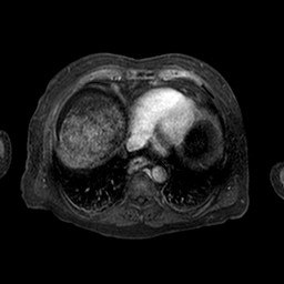Cirrhosis and hepatocellular carcinoma in the setting of hemochromatosis (Radiopaedia 75394-86594 Axial T1 C+ fat sat 246).jpg