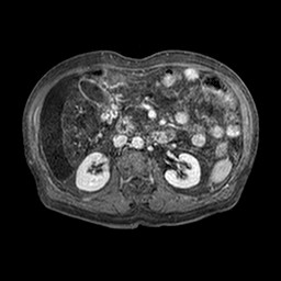 Cirrhosis and hepatocellular carcinoma in the setting of hemochromatosis (Radiopaedia 75394-86594 Axial T1 C+ fat sat 279).jpg