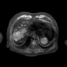 Cirrhosis and hepatocellular carcinoma in the setting of hemochromatosis (Radiopaedia 75394-86594 Axial T1 C+ fat sat 64).jpg