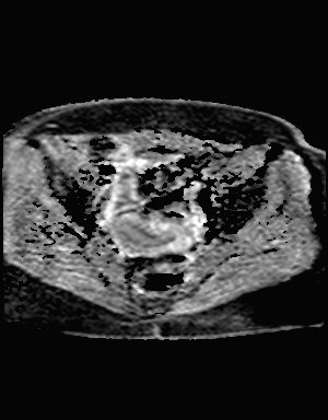 File:Class II Mullerian duct anomaly- unicornuate uterus with rudimentary horn and non-communicating cavity (Radiopaedia 39441-41755 Axial ADC 15).jpg