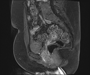 File:Class II Mullerian duct anomaly- unicornuate uterus with rudimentary horn and non-communicating cavity (Radiopaedia 39441-41755 G 60).jpg