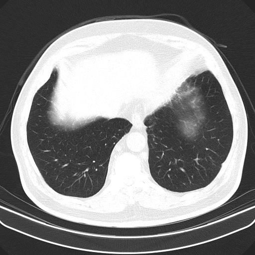 Classic complicated silicosis (Radiopaedia 49720-54961 Axial lung window 48).jpg