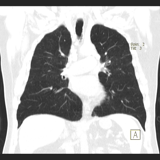 File:Classic complicated silicosis (Radiopaedia 49720-54961 Coronal lung window 31).jpg