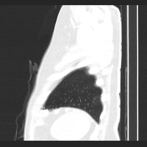 File:Classic complicated silicosis (Radiopaedia 49720-54961 Sagittal lung window 5).jpg