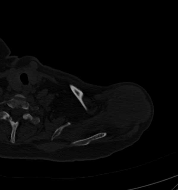 Clear cell chondrosarcoma - humerus (Radiopaedia 63104-71612 Axial bone window 17).jpg