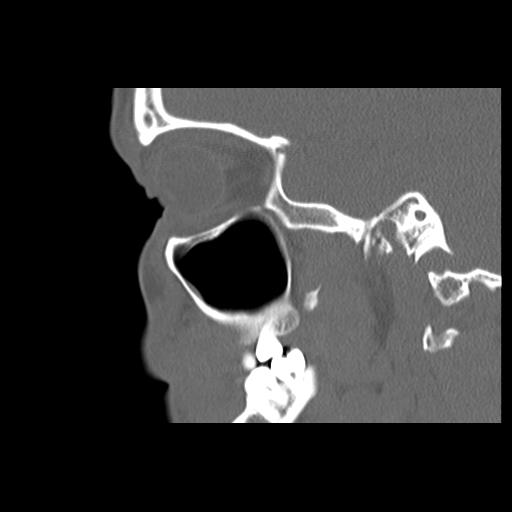 Cleft hard palate and alveolus (Radiopaedia 63180-71710 Sagittal bone window 35).jpg