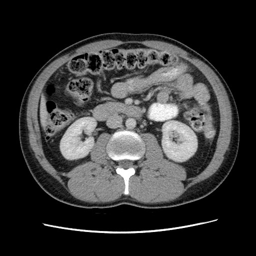 File:Closed-loop small bowel obstruction (Radiopaedia 73713-84509 A 74).jpg