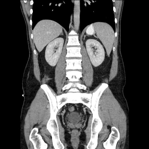 Closed-loop small bowel obstruction (Radiopaedia 73713-84509 C 84).jpg
