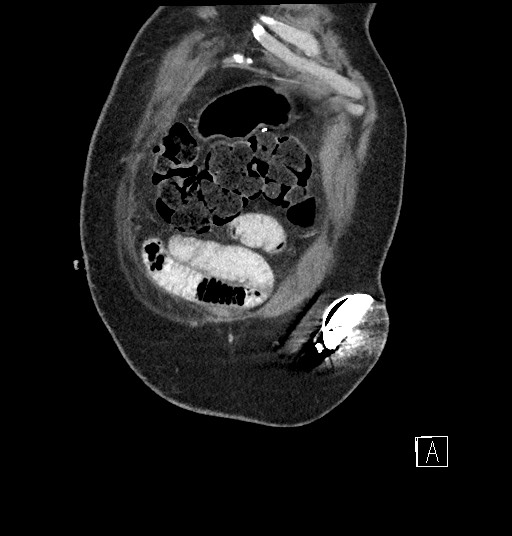 File:Closed loop obstruction - internal hernia into nephrectomy bed (Radiopaedia 59867-67320 B 4).jpg