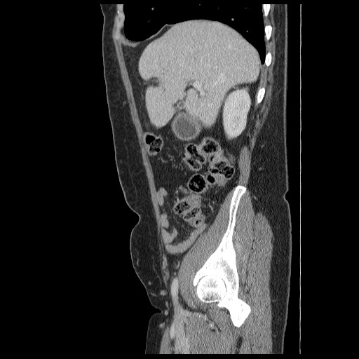 Closed loop small bowel obstruction (Radiopaedia 65403-74451 C 23).jpg