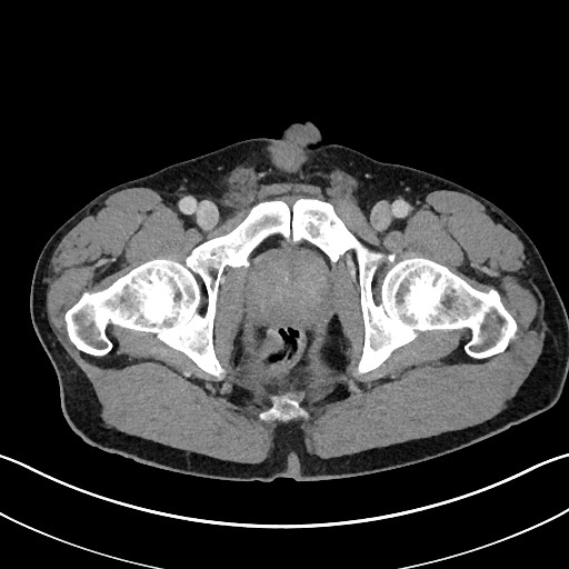 Closed loop small bowel obstruction - internal hernia (Radiopaedia 57806-64778 B 125).jpg