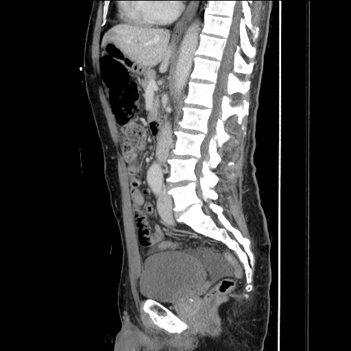 Closed loop small bowel obstruction - omental adhesion causing "internal hernia" (Radiopaedia 85129-100682 C 92).jpg