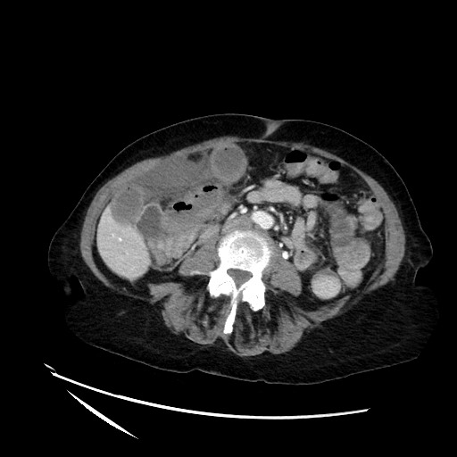 File:Closed loop small bowel obstruction due to adhesive band, with intramural hemorrhage and ischemia (Radiopaedia 83831-99017 Axial 7).jpg
