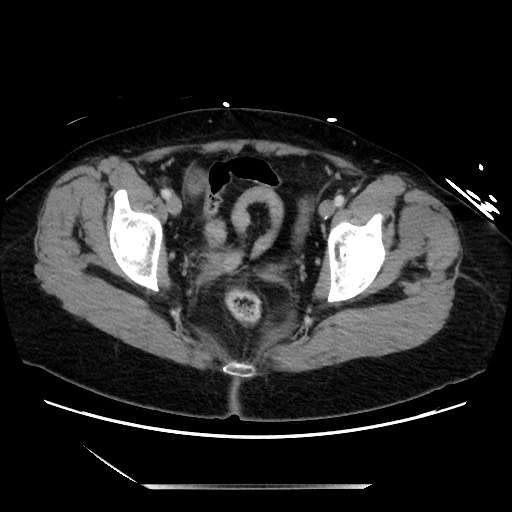 File:Closed loop small bowel obstruction due to adhesive bands - early and late images (Radiopaedia 83830-99014 A 139).jpg