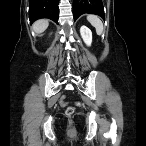 Closed loop small bowel obstruction due to adhesive bands - early and late images (Radiopaedia 83830-99014 B 96).jpg