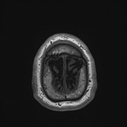 File:Cochlear incomplete partition type III associated with hypothalamic hamartoma (Radiopaedia 88756-105498 Axial T1 181).jpg