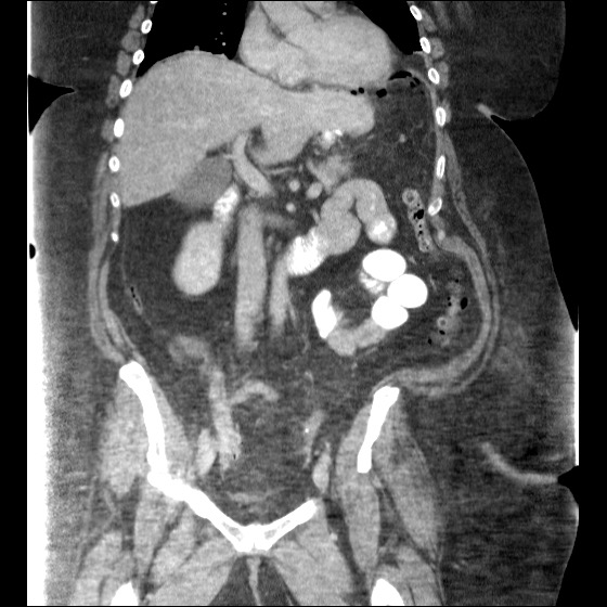 Collection due to leak after sleeve gastrectomy (Radiopaedia 55504-61972 B 25).jpg