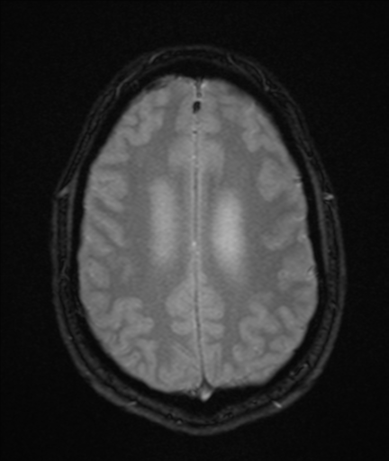 File:Colloid cyst (Radiopaedia 44510-48181 Axial Gradient Echo 20).png