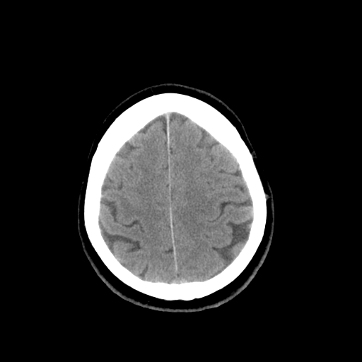 File:Colloid cyst (large) (Radiopaedia 34415-35734 Axial non-contrast 47).png