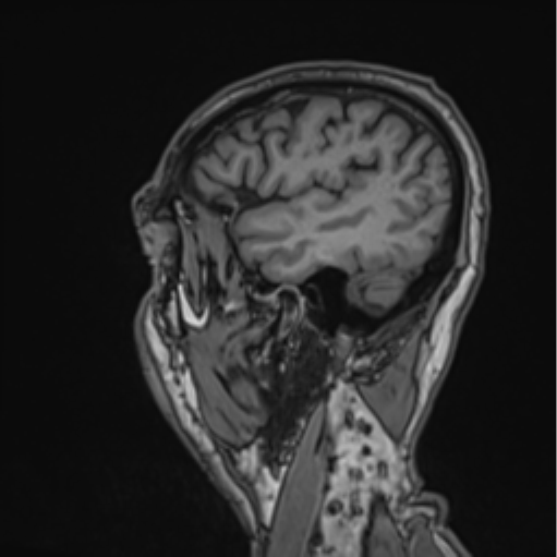File:Colloid cyst of the third ventricle (Radiopaedia 86571-102662 Sagittal T1 15).png
