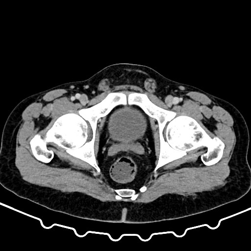 Colocolic intussusception due to large lipoma (Radiopaedia 68773-78482 A 187).jpg