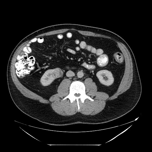 Colocolic intussusception due to lipoma (Radiopaedia 73712-84508 A 60).jpg