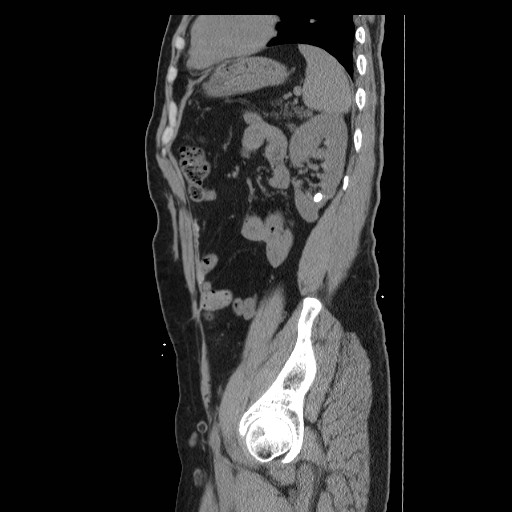 File:Colocutaneous fistula in Crohn's disease (Radiopaedia 29586-30093 C 46).jpg