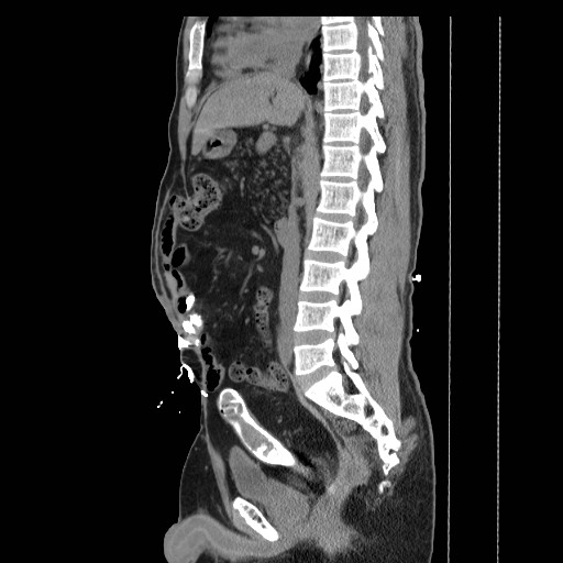 Colocutaneous fistula in Crohn's disease (Radiopaedia 29586-30093 F 13).jpg