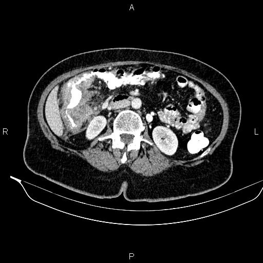 Colon adenocarcinoma (Radiopaedia 91240-108842 A 41).jpg