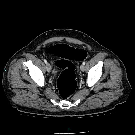 Colon adenocarcinoma with calcific liver metastasis (Radiopaedia 55745-62300 B 40).jpg