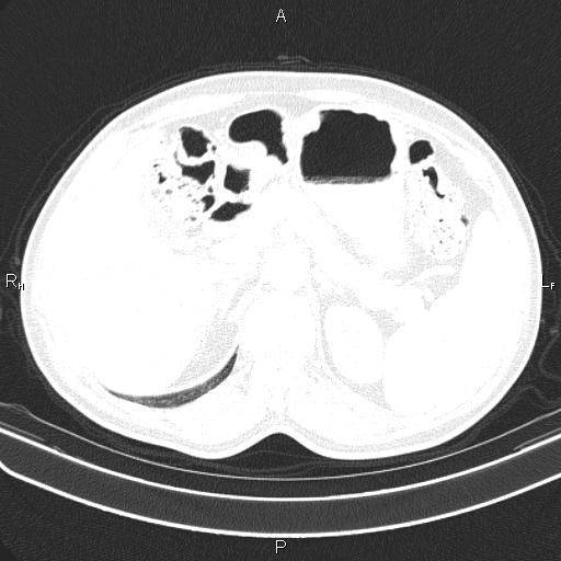 File:Colon cancer (Radiopaedia 85663-101443 Axial lung window 68).jpg