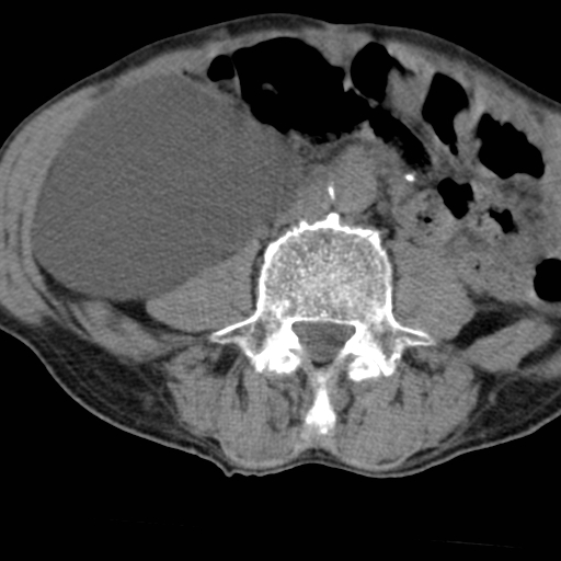 File:Colon cancer with calcified liver metastasis (Radiopaedia 74423-85309 Axial non-contrast 60).jpg