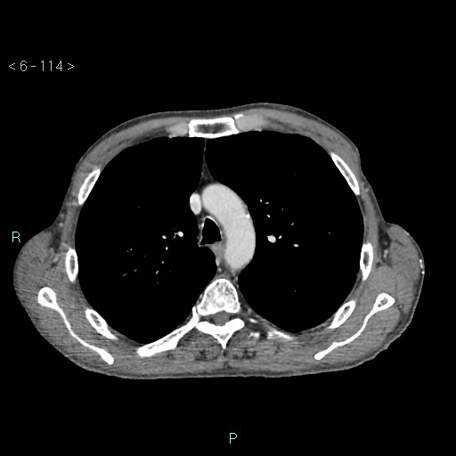 Colonic cancer (ultrasound and TC imaging) (Radiopaedia 50346-55713 B 114).jpg