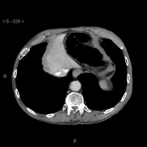 Colonic cancer (ultrasound and TC imaging) (Radiopaedia 50346-55713 B 326).jpg