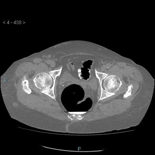 Colonic lipomas (Radiopaedia 49137-54244 Axial bone window 196).jpg